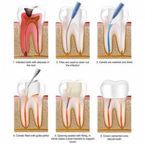 root canal treatment the steps