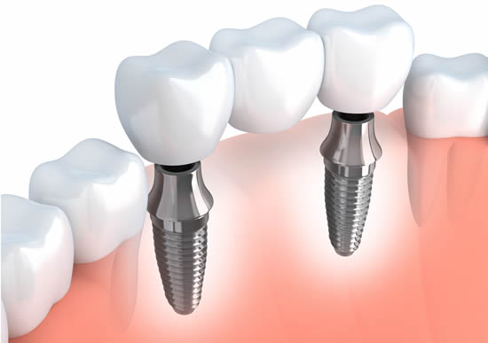 What Contributes To A Successful Dental Implant Procedure?