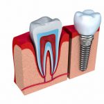 dental implant next to natural tooth
