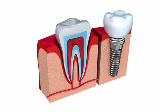 Long Lasting Dental Implants In Wickford, Essex