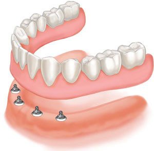 Implant stabilised dentures