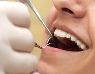 The Advantages Of White Dental Fillings