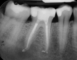 About Your Rear Teeth (Molars)